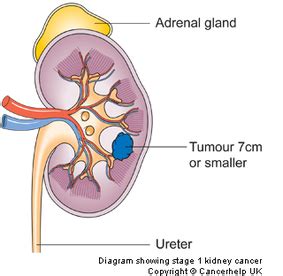 Stages - Kidney Cancer