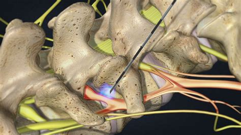 Epidural Steroid Injection — EPIC PAIN MANAGEMENT