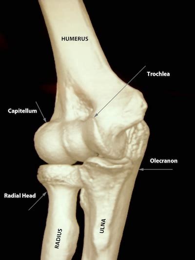 Radial head fracture - ElbowDoc