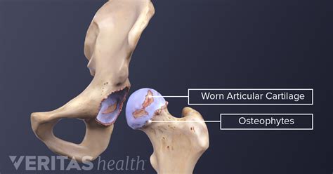 What is Hip Osteoarthritis? | Arthritis-Health