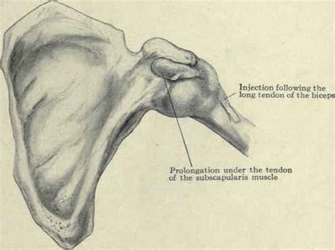 Diseases Of The Joint And Bursae. Continued