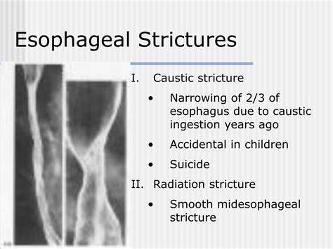 Esophageal Stricture