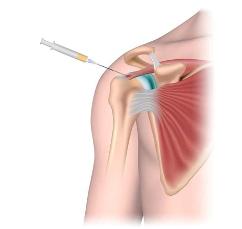 Shoulder Pain & Arthritis | Ohio Healthcare Partners | Fairlawn, OH