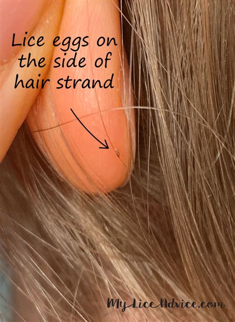 Pictures of What Lice Eggs (Nits) Look Like in Hair: 9 Tips to Spot Them