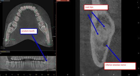 Wisdom Teeth Nerve Damage | North Texas Dental Surgery