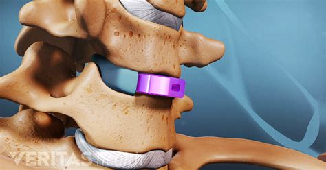 ACDF: Anterior Cervical Discectomy and Fusion