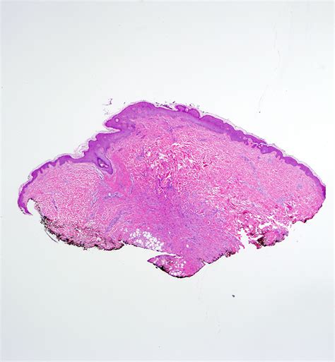 Dermatofibroma Histology