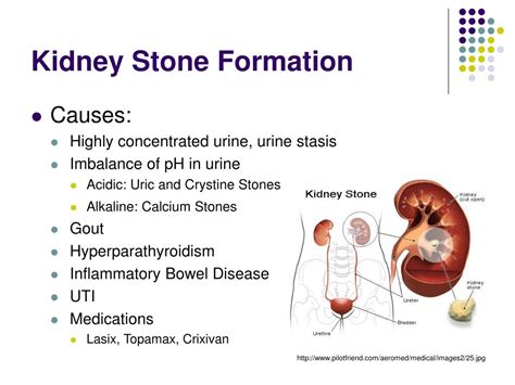 PPT - Kidney Stones PowerPoint Presentation - ID:23768