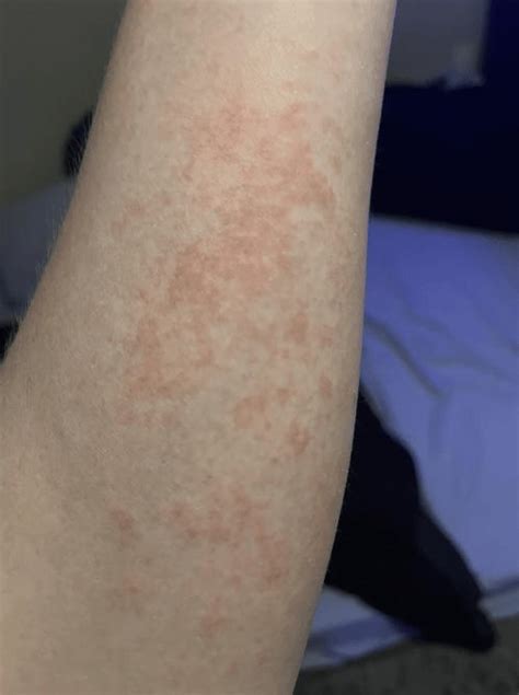 Hand Acne Bad Arm Rashes Raccutane