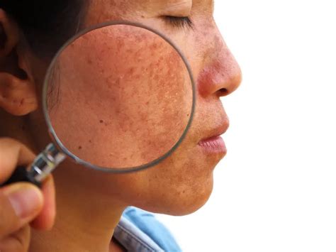 Melasma: Causes, Symptoms and Treatments | STD.GOV Blog