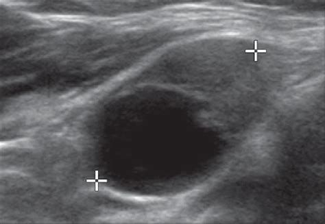 Ultrasound Of Lymph Nodes In Neck