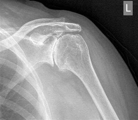 Shoulder X-ray Findings not Related to Pain-No Surprises Here