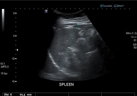 File:Spleen ultrasound.jpg - Wikimedia Commons