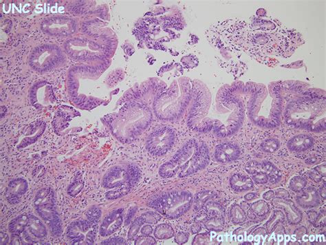 intestinal metaplasia esophagus histology