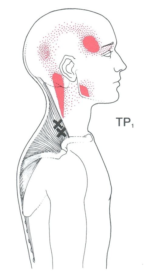 Trapezius | The Trigger Point & Referred Pain Guide