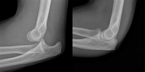 Congenital Dislocation of the Radial Head - International Limb ...