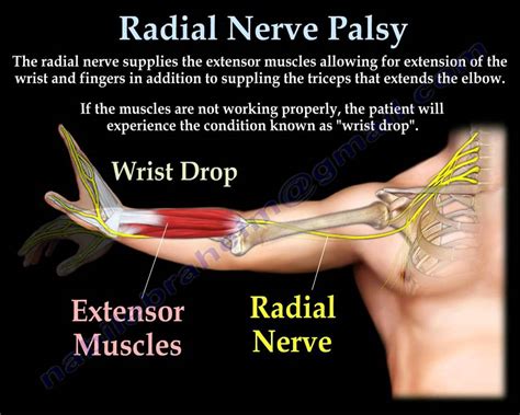 Radial Nerve: Radial Nerve Palsy Splint Youtube