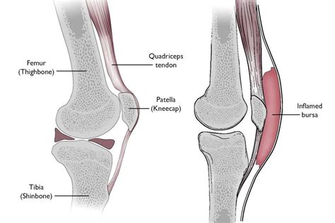 Prepatellar (Kneecap) Bursitis – Modern Orthopaedics of New Jersey