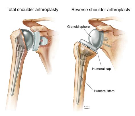 Shoulder Surgery | Templeton, CA | Dr William Sima, MD