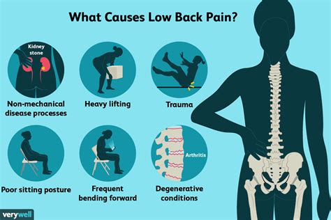 Lower Back Pain Causes - Chronic Lower Back Pain - Chronic Lower Back ...