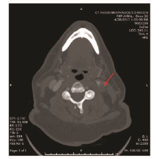 CT angiogram head and neck. Note the occlusion of the left internal ...