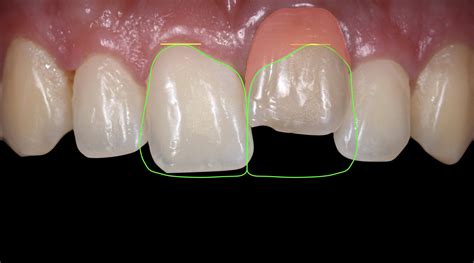 Minimally Invasive Treatment of an Ankylosed Tooth with a Ceramic ...