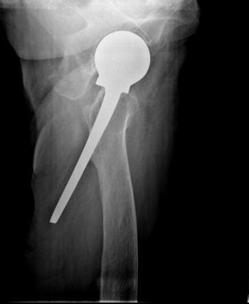 Complications of total hip arthroplasty | Radiology Reference Article ...