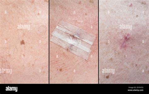 Dermatofibroma Removal Scar Pictures