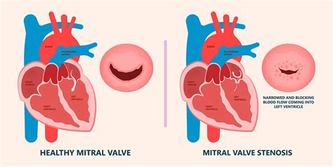 Mitral Valve Diagram