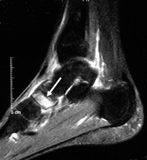 Avulsion Fracture Navicular Bone Foot