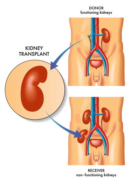 Kidney Transplant - Harvard Health