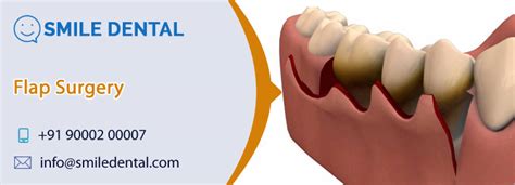 Gingival Flap Surgery In Dilsukhnagar » Smile Dental