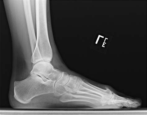 Big toe arthritis — Tonya An, MD