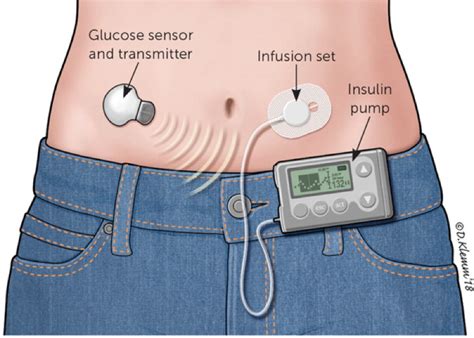 Insulin Pump Catheter