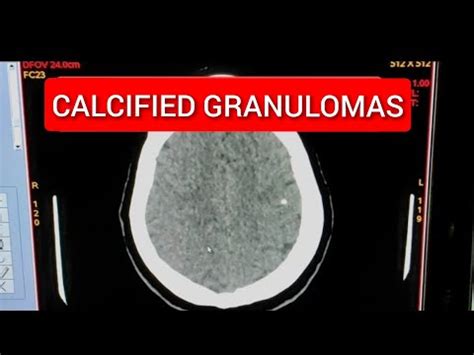 Calcified Granulomas in Brain. - YouTube