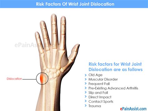 Wrist Dislocation