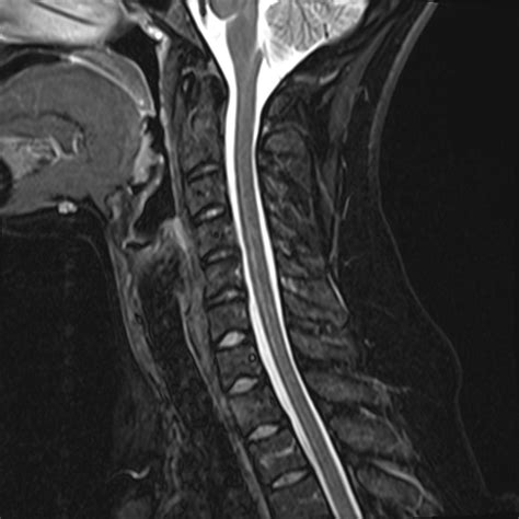 Cervical Spine Mri Normal | www.galleryhip.com - The Hippest Pics