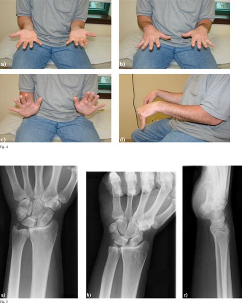 Dislocated wrist | Semantic Scholar