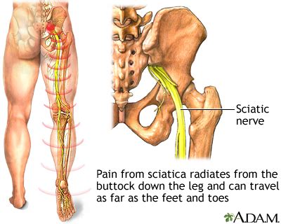 Sciatica Symptoms, Doctors, Treatments, Advances & More | MediFind