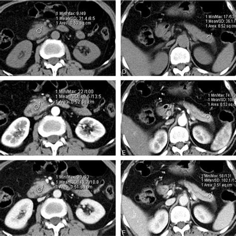 A 47-year-old man with pancreatic adenocarcinoma confined in the ...