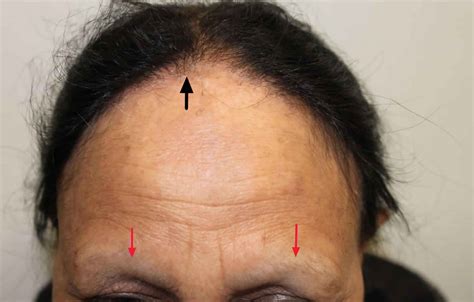 Frontal fibrosing alopecia causes, symptoms, diagnosis, treatment ...