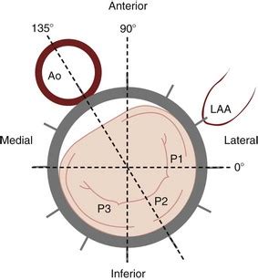 Myxomatous Mitral Valve Disease | Thoracic Key