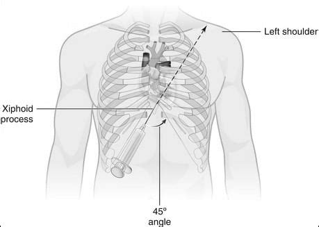 Pericardiocentesis • LITFL • CCC Procedure