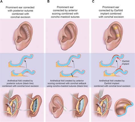 Prominent Ear Correction Surgery Cost in Turkey Istanbul | Dr.Resat AKTAS