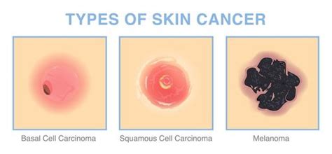 Skin Cancer Treatment for Head and Neck - ENT Center of Excellence