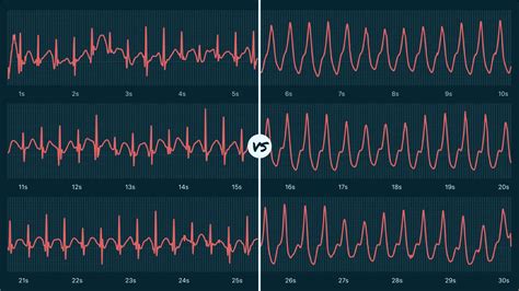 Supraventricular Tachycardia Sustained Vs Ventricular Tachycardia