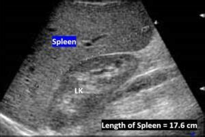 Spleen Ultrasound – How to Measure Length of the Spleen and Assess for ...