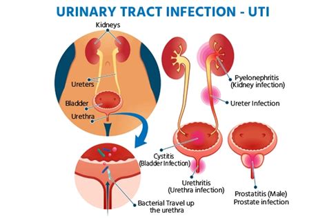 Urinary Tract Infection Men Discharge