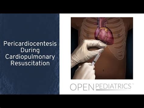 "Pericardiocentesis During Cardiopulmonary Resuscitation" by Dr. Traci ...