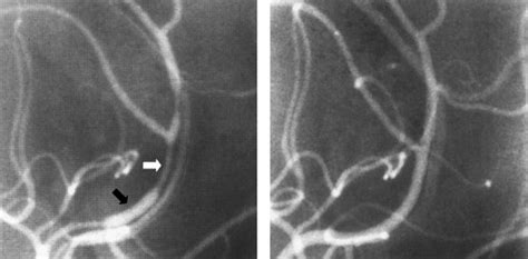 Primary angiitis of the central nervous system: differential diagnosis ...